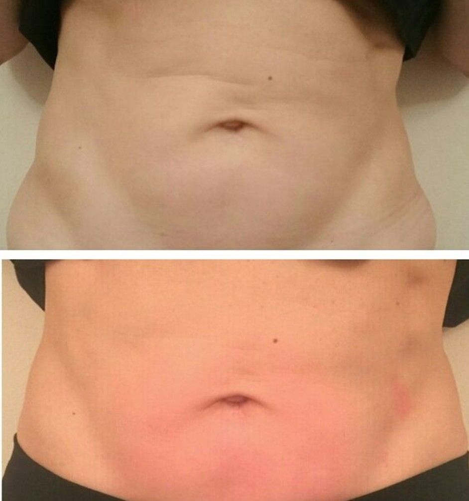 Dermaplaning exfoliation treatment at Unique Boutique Your Day of Beauty in Newton Centre, MA