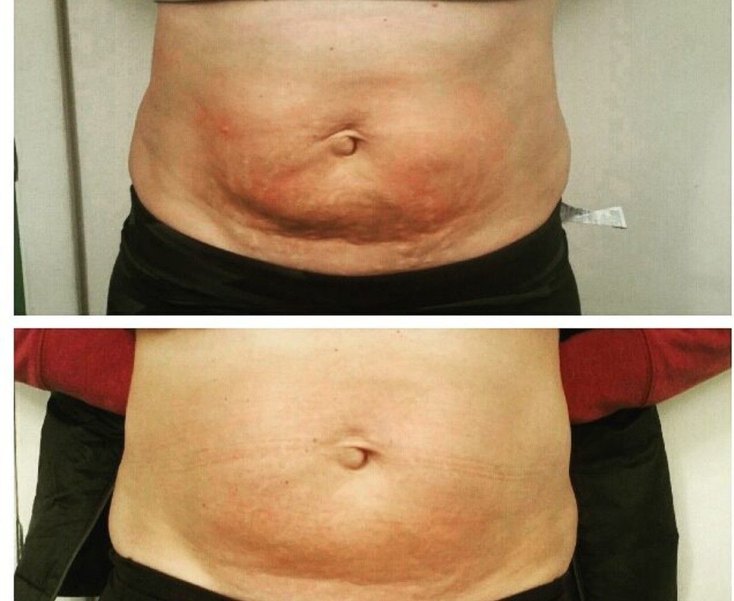 Non-invasive body contouring treatment at Unique Boutique Your Day of Beauty in Newton Centre, MA