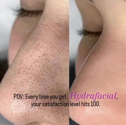 Unique Boutique Your Day of Beauty in Newton Centre — HydraFacial MD glow-up