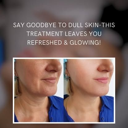 Microcurrent facial lifting treatment at Unique Boutique Your Day of Beauty in Newton Centre, MA
